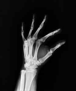 spiraling bones